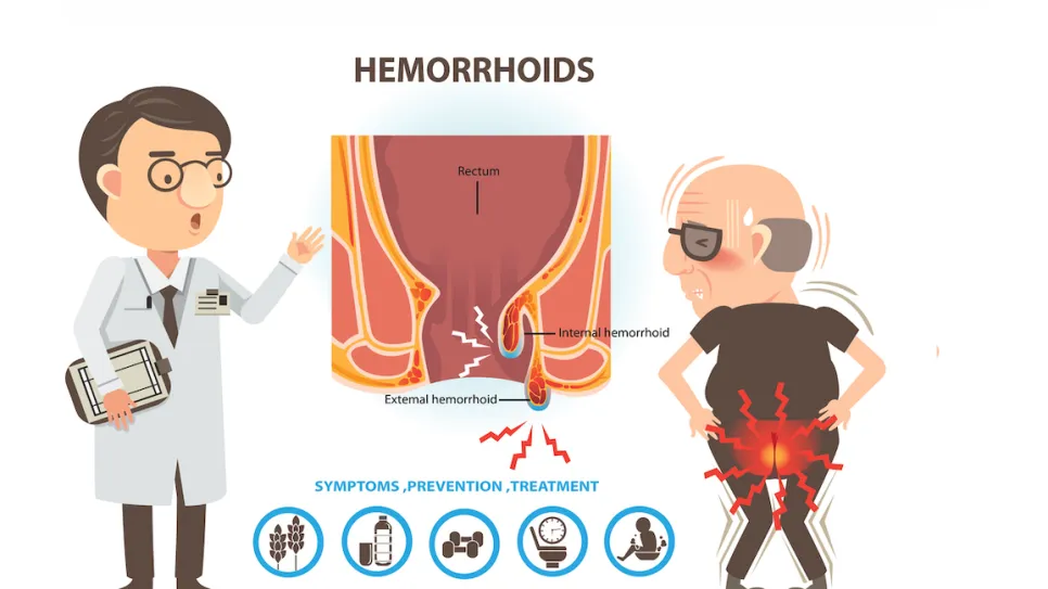 hemorrhoids-symptom3.png